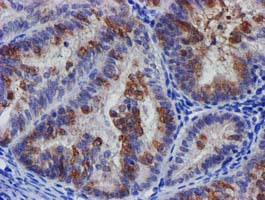 SLFNL1 Antibody - IHC of paraffin-embedded Adenocarcinoma of Human endometrium tissue using anti-SLFNL1 mouse monoclonal antibody.