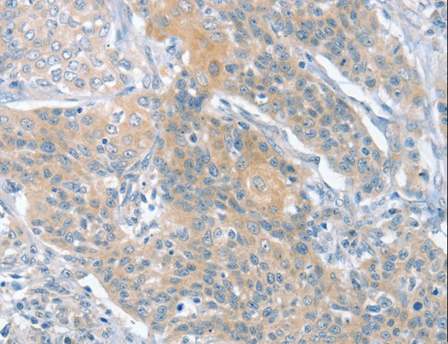 SLIT2 Antibody - Immunohistochemistry of paraffin-embedded Human cervical cancer using SLIT2 Polyclonal Antibody at dilution of 1:30.