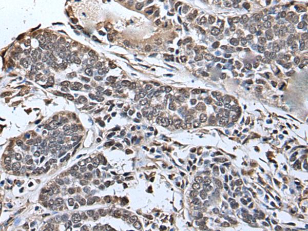 SLITRK5 Antibody - Immunohistochemistry of paraffin-embedded Human esophagus cancer tissue  using SLITRK5 Polyclonal Antibody at dilution of 1:45(×200)