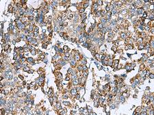 SLMO2 Antibody - Immunohistochemistry of paraffin-embedded Human liver cancer tissue  using PRELID3B Polyclonal Antibody at dilution of 1:90(×200)