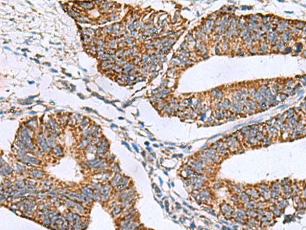SLMO2 Antibody - Immunohistochemistry of paraffin-embedded Human colorectal cancer tissue  using PRELID3B Polyclonal Antibody at dilution of 1:90(×200)