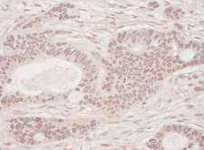 SLTM Antibody - Detection of Human SLTM by Immunohistochemistry. Sample: FFPE section of human ovarian carcinoma. Antibody: Affinity purified rabbit anti-SLTM used at a dilution of 1:200 (1 Detection: Vector Laboratories ImmPACT NovaRED Peroxidase Substrate.