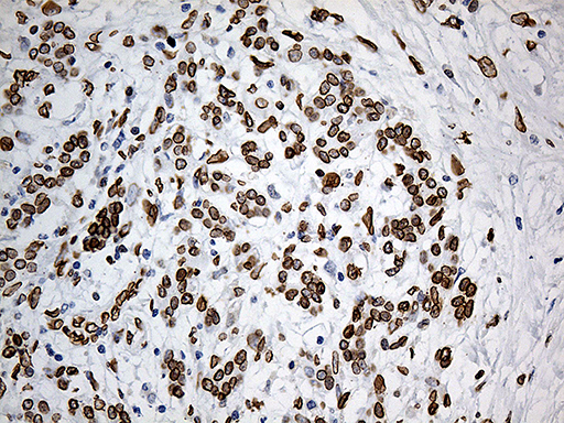 SLU7 / 9G8 Antibody - Immunohistochemical staining of paraffin-embedded Carcinoma of Human pancreas tissue using anti-SLU7 mouse monoclonal antibody. (Heat-induced epitope retrieval by 1mM EDTA in 10mM Tris buffer. (pH8.5) at 120°C for 3 min. (1:1000)