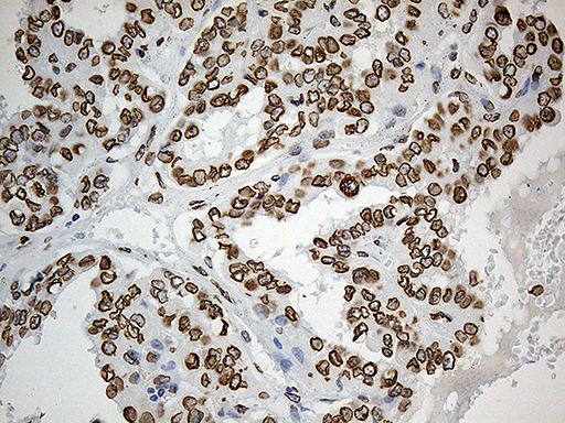 SLU7 / 9G8 Antibody - Immunohistochemical staining of paraffin-embedded Carcinoma of Human thyroid tissue using anti-SLU7 mouse monoclonal antibody. (Heat-induced epitope retrieval by 1mM EDTA in 10mM Tris buffer. (pH8.5) at 120°C for 3 min. (1:1000)