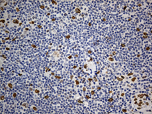 SLU7 / 9G8 Antibody - Immunohistochemical staining of paraffin-embedded Human lymphoma tissue using anti-SLU7 mouse monoclonal antibody. (Heat-induced epitope retrieval by 1mM EDTA in 10mM Tris buffer. (pH8.5) at 120°C for 3 min. (1:1000)