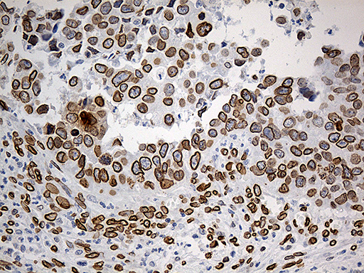 SLU7 / 9G8 Antibody - Immunohistochemical staining of paraffin-embedded Carcinoma of Human kidney tissue using anti-SLU7 mouse monoclonal antibody. (Heat-induced epitope retrieval by 1mM EDTA in 10mM Tris buffer. (pH8.5) at 120°C for 3 min. (1:1000)