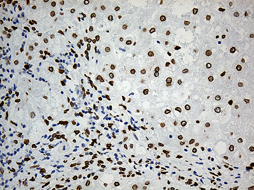 SLU7 / 9G8 Antibody - Immunohistochemical staining of paraffin-embedded Carcinoma of Human liver tissue using anti-SLU7 mouse monoclonal antibody. (Heat-induced epitope retrieval by 1mM EDTA in 10mM Tris buffer. (pH8.5) at 120°C for 3 min. (1:1000)