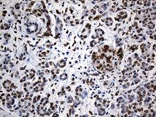 SLU7 / 9G8 Antibody - Immunohistochemical staining of paraffin-embedded Carcinoma of Human pancreas tissue using anti-SLU7 mouse monoclonal antibody. (Heat-induced epitope retrieval by 1mM EDTA in 10mM Tris buffer. (pH8.5) at 120°C for 3 min. (1:500)