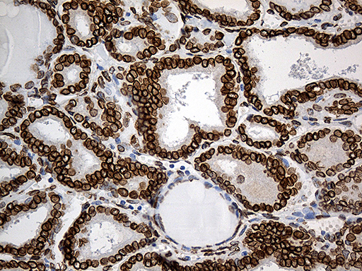 SLU7 / 9G8 Antibody - Immunohistochemical staining of paraffin-embedded Carcinoma of Human thyroid tissue using anti-SLU7 mouse monoclonal antibody. (Heat-induced epitope retrieval by 1mM EDTA in 10mM Tris buffer. (pH8.5) at 120°C for 3 min. (1:500)