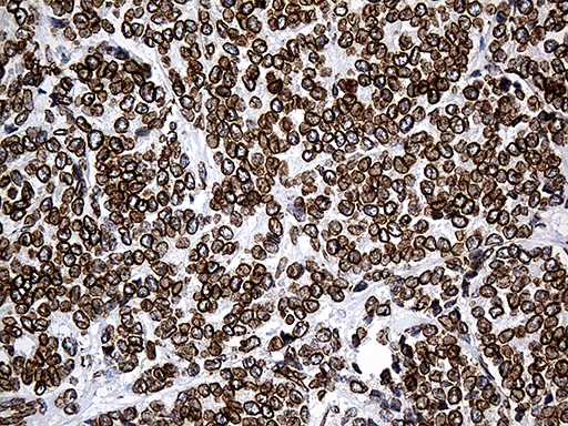 SLU7 / 9G8 Antibody - Immunohistochemical staining of paraffin-embedded Adenocarcinoma of Human breast tissue tissue using anti-SLU7 mouse monoclonal antibody. (Heat-induced epitope retrieval by 1mM EDTA in 10mM Tris buffer. (pH8.5) at 120°C for 3 min. (1:500)