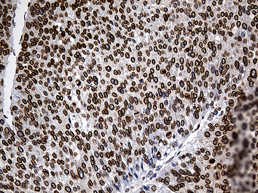 SLU7 / 9G8 Antibody - Immunohistochemical staining of paraffin-embedded Carcinoma of Human liver tissue using anti-SLU7 mouse monoclonal antibody. (Heat-induced epitope retrieval by 1mM EDTA in 10mM Tris buffer. (pH8.5) at 120°C for 3 min. (1:500)