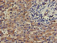 SLU7 / 9G8 Antibody - Immunohistochemistry of paraffin-embedded human liver cancer using SLU7 Antibody at dilution of 1:100