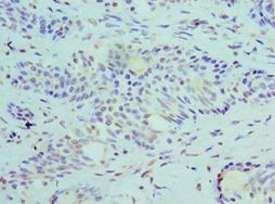 SLURP1 / ARS / MDM Antibody - Immunohistochemistry of paraffin-embedded human breast cancer using antibody at 1:100 dilution.