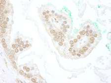 SLX4 Antibody - Detection of Human BTBD12 by Immunohistochemistry. Sample: FFPE section of human prostate carcinoma. Antibody: Affinity purified rabbit anti-BTBD12 used at a dilution of 1:250.