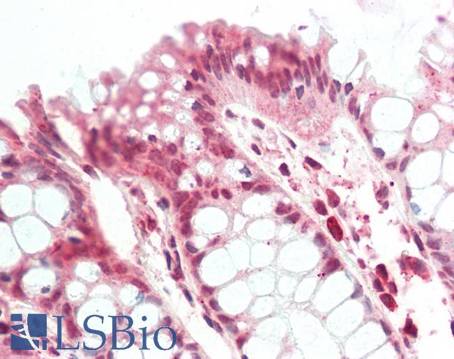 SMAD1 Antibody - Human, Colon: Formalin-Fixed Paraffin-Embedded (FFPE).  This image was taken for the unconjugated form of this product. Other forms have not been tested.