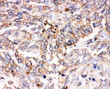 SMAD1 Antibody - SMAD1 antibody. IHC(P): Human Lung Cancer Tissue.