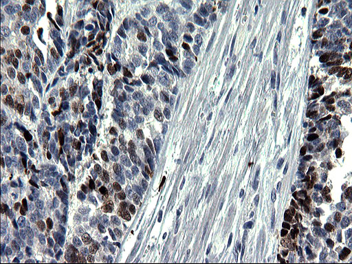 SMAD1 Antibody - IHC of paraffin-embedded Adenocarcinoma of Human colon tissue using anti-SMAD1 mouse monoclonal antibody. (Heat-induced epitope retrieval by 1 mM EDTA in 10mM Tris, pH8.5, 120°C for 3min).