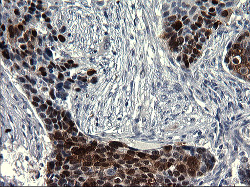 SMAD1 Antibody - IHC of paraffin-embedded Carcinoma of Human lung tissue using anti-SMAD1 mouse monoclonal antibody. (Heat-induced epitope retrieval by 1 mM EDTA in 10mM Tris, pH8.5, 120°C for 3min).