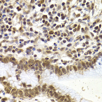 SMAD1 Antibody - Immunohistochemistry of paraffin-embedded human stomach cancer tissue.