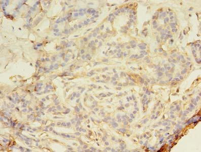SMAD1 Antibody - Immunohistochemistry of paraffin-embedded human breast cancer using antibody at dilution of 1:100.