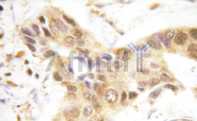 SMAD1 Antibody - 1/100 staining human breast  tissue by IHC-P. The sample was formaldehyde fixed and a heat mediated antigen retrieval step in citrate buffer was performed. The sample was then blocked and incubated with the antibody for 1.5 hours at 22°C. An HRP conjugated goat anti-rabbit antibody was used as the secondary antibody.