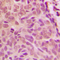 SMAD1 Antibody - Immunohistochemical analysis of SMAD1 staining in human breast cancer formalin fixed paraffin embedded tissue section. The section was pre-treated using heat mediated antigen retrieval with sodium citrate buffer (pH 6.0). The section was then incubated with the antibody at room temperature and detected using an HRP conjugated compact polymer system. DAB was used as the chromogen. The section was then counterstained with hematoxylin and mounted with DPX.