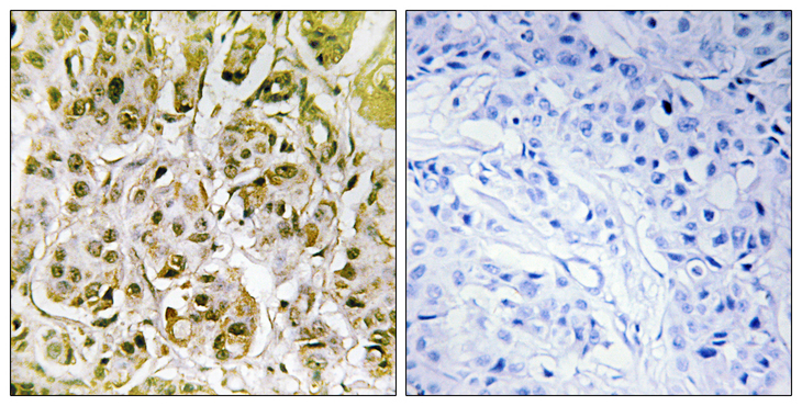 SMAD1 Antibody - Immunohistochemistry analysis of paraffin-embedded human breast carcinoma, using Smad1 (Phospho-Ser187) Antibody. The picture on the right is blocked with the phospho peptide.
