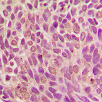 SMAD1 Antibody - Immunohistochemical analysis of SMAD1 (pS187) staining in human breast cancer formalin fixed paraffin embedded tissue section. The section was pre-treated using heat mediated antigen retrieval with sodium citrate buffer (pH 6.0). The section was then incubated with the antibody at room temperature and detected using an HRP conjugated compact polymer system. DAB was used as the chromogen. The section was then counterstained with hematoxylin and mounted with DPX.