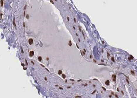 SMAD1 Antibody - 1:100 staining human lung carcinoma tissue by IHC-P. The tissue was formaldehyde fixed and a heat mediated antigen retrieval step in citrate buffer was performed. The tissue was then blocked and incubated with the antibody for 1.5 hours at 22°C. An HRP conjugated goat anti-rabbit antibody was used as the secondary.