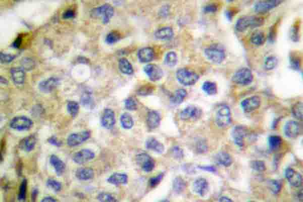 SMAD1 Antibody - IHC of Smad1 (P457) pAb in paraffin-embedded human breast carcinoma tissue.