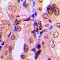SMAD2 Antibody - Immunohistochemical analysis of SMAD2 (pS465) staining in human breast cancer formalin fixed paraffin embedded tissue section. The section was pre-treated using heat mediated antigen retrieval with sodium citrate buffer (pH 6.0). The section was then incubated with the antibody at room temperature and detected using an HRP-conjugated compact polymer system. DAB was used as the chromogen. The section was then counterstained with hematoxylin and mounted with DPX.