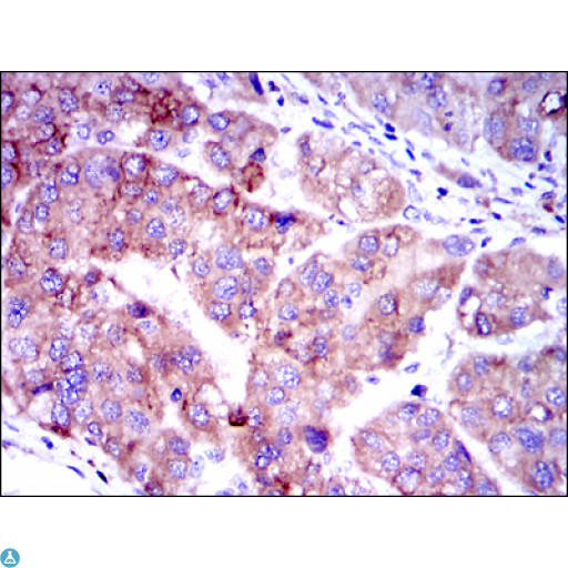 SMAD2 Antibody - Immunohistochemistry (IHC) analysis of paraffin-embedded Human Liver Cancer Tissues with DAB staining using Smad2 Monoclonal Antibody.
