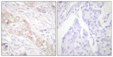 SMAD2 Antibody - Immunohistochemistry analysis of paraffin-embedded human breast carcinoma, using Smad2 (Phospho-Ser467) Antibody. The picture on the right is blocked with the phospho peptide.