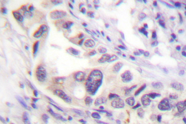 SMAD2 Antibody - IHC of Smad2 (P459) pAb in paraffin-embedded human prostate carcinoma lung carcinoma tissue.