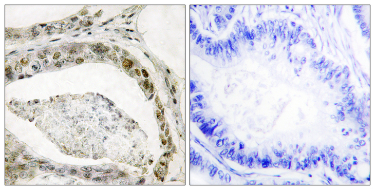 SMAD3 Antibody - Immunohistochemistry analysis of paraffin-embedded human colon carcinoma, using Smad3 (Phospho-Ser208) Antibody. The picture on the right is blocked with the phospho peptide.