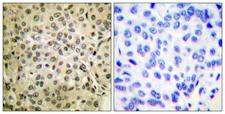 SMAD3 Antibody - Immunohistochemistry analysis of paraffin-embedded human breast carcinoma tissue, using Smad3 Antibody. The picture on the right is blocked with the synthesized peptide.