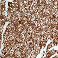 SMAD3 Antibody - Immunohistochemical analysis of SMAD3 staining in human liver;human colon cancer formalin fixed paraffin embedded tissue section. The section was pre-treated using heat mediated antigen retrieval with sodium citrate buffer (pH 6.0). The section was then incubated with the antibody at room temperature and detected using an HRP conjugated compact polymer system. DAB was used as the chromogen. The section was then counterstained with hematoxylin and mounted with DPX.