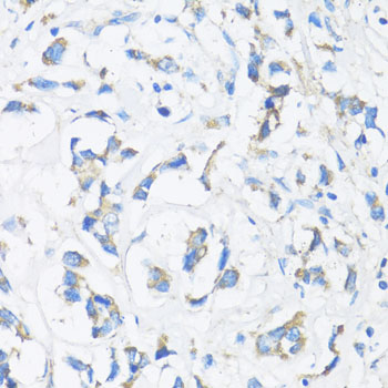 SMAD3 Antibody - Immunohistochemistry of paraffin-embedded human mammary cancer using SMAD3 antibody at dilution of 1:100 (40x lens).
