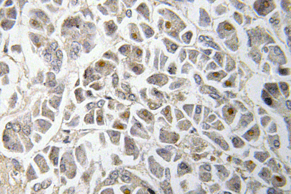 SMAD3 Antibody - IHC of Smad3 (M200) pAb in paraffin-embedded human colon carcinoma tissue.