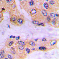 SMAD3 Antibody - Immunohistochemical analysis of SMAD3 (pS213) staining in human prostate cancer formalin fixed paraffin embedded tissue section. The section was pre-treated using heat mediated antigen retrieval with sodium citrate buffer (pH 6.0). The section was then incubated with the antibody at room temperature and detected using an HRP conjugated compact polymer system. DAB was used as the chromogen. The section was then counterstained with hematoxylin and mounted with DPX.