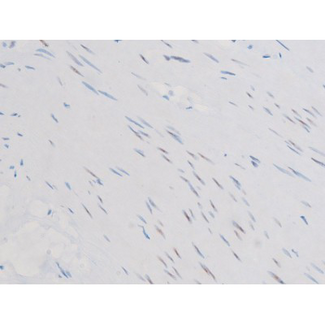 SMAD3 Antibody - 1:200 staining human prostate tissue by IHC-P. The tissue was formaldehyde fixed and a heat mediated antigen retrieval step in citrate buffer was performed. The tissue was then blocked and incubated with the antibody for 1.5 hours at 22°C. An HRP conjugated goat anti-rabbit antibody was used as the secondary.