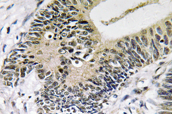 SMAD3 Antibody - IHC of Smad3 (P209) pAb in paraffin-embedded human colon carcinoma tissue.
