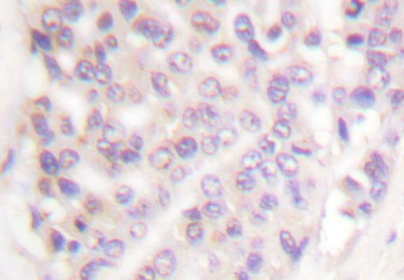 SMAD3 Antibody - IHC of Smad3 (P417) pAb in paraffin-embedded human breast carcinoma tissue.