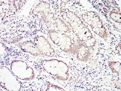 SMAD4 Antibody - Immunohistochemical analysis of paraffin- embedded lung cancer tissues using SMAD4 mouse mAb with DAB staining.