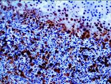 SMAD4 Antibody - IHC of SMAD4 / DPC4 on an FFPE Pancreatic Cancer Tissue