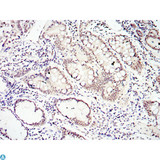 SMAD4 Antibody - Immunohistochemistry (IHC) analysis of paraffin-embedded Lung Cancer Tissues with DAB staining using Smad4 Monoclonal Antibody.