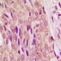 SMAD4 Antibody - Immunohistochemical analysis of SMAD4 staining in human breast cancer formalin fixed paraffin embedded tissue section. The section was pre-treated using heat mediated antigen retrieval with sodium citrate buffer (pH 6.0). The section was then incubated with the antibody at room temperature and detected using an HRP conjugated compact polymer system. DAB was used as the chromogen. The section was then counterstained with hematoxylin and mounted with DPX.