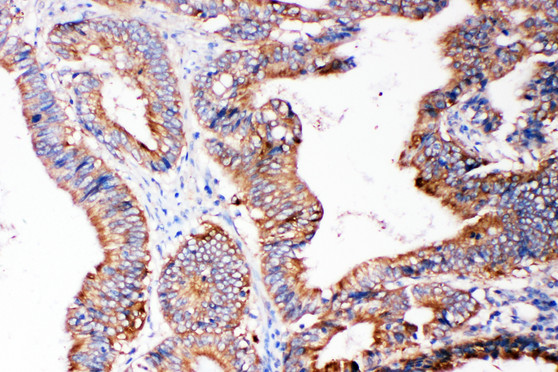 SMAD5 Antibody - SMAD5 antibody. IHC(P): Human Intestinal Cancer Tissue.