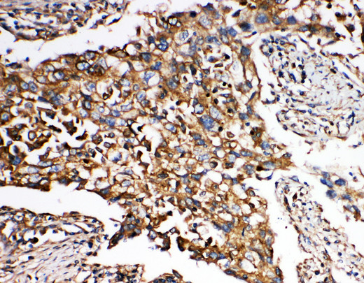 SMAD5 Antibody - SMAD5 antibody. IHC(P): Human Lung Cancer Tissue.