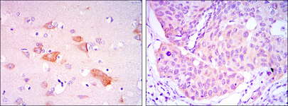 SMAD5 Antibody - IHC of paraffin-embedded brain tissues (left) and lung cancer tissues (right) using SMAD5 mouse monoclonal antibody with DAB staining.